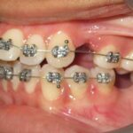 dental Brace