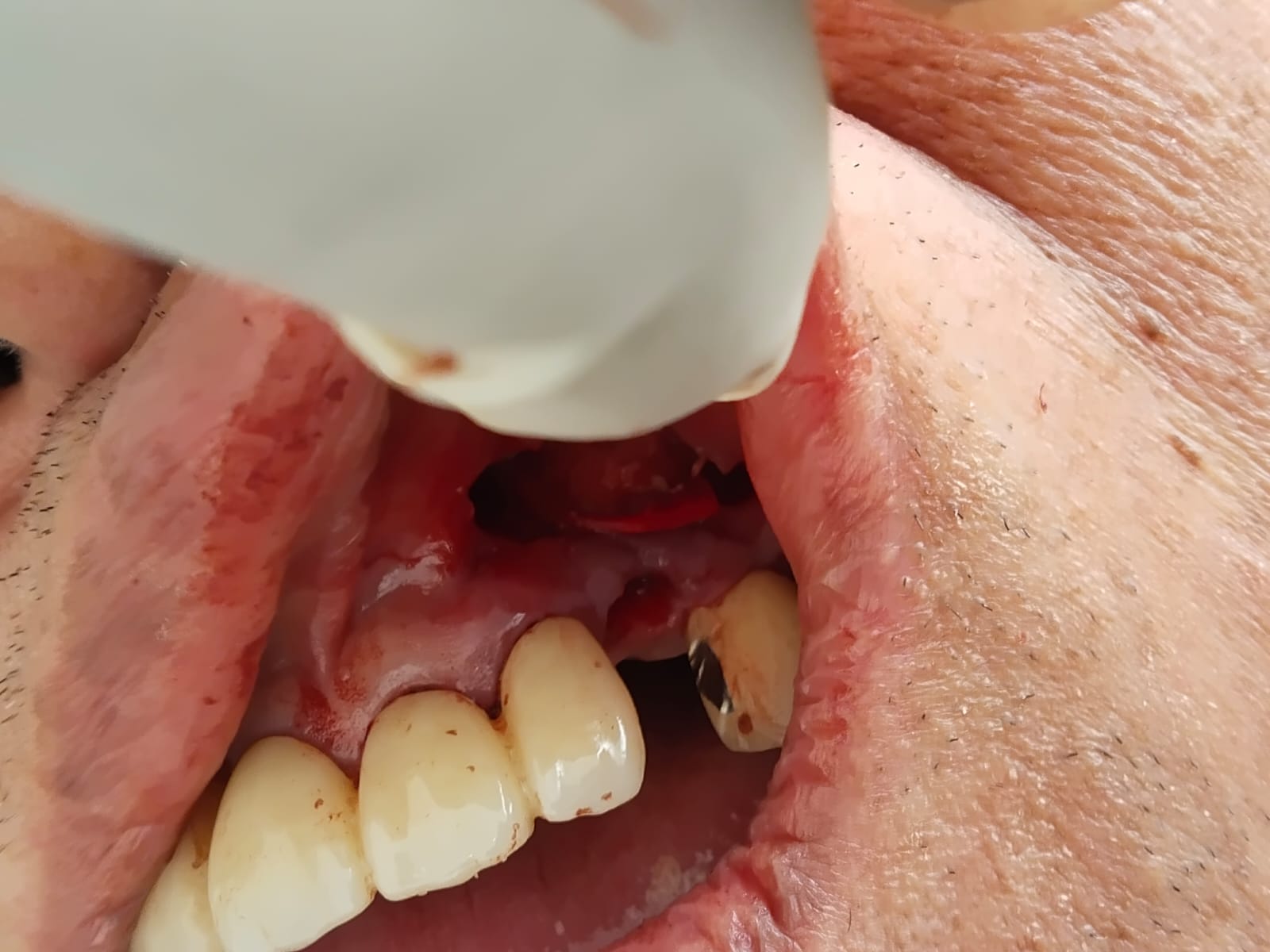 best wisdom tooth extraction doctor in dhaka