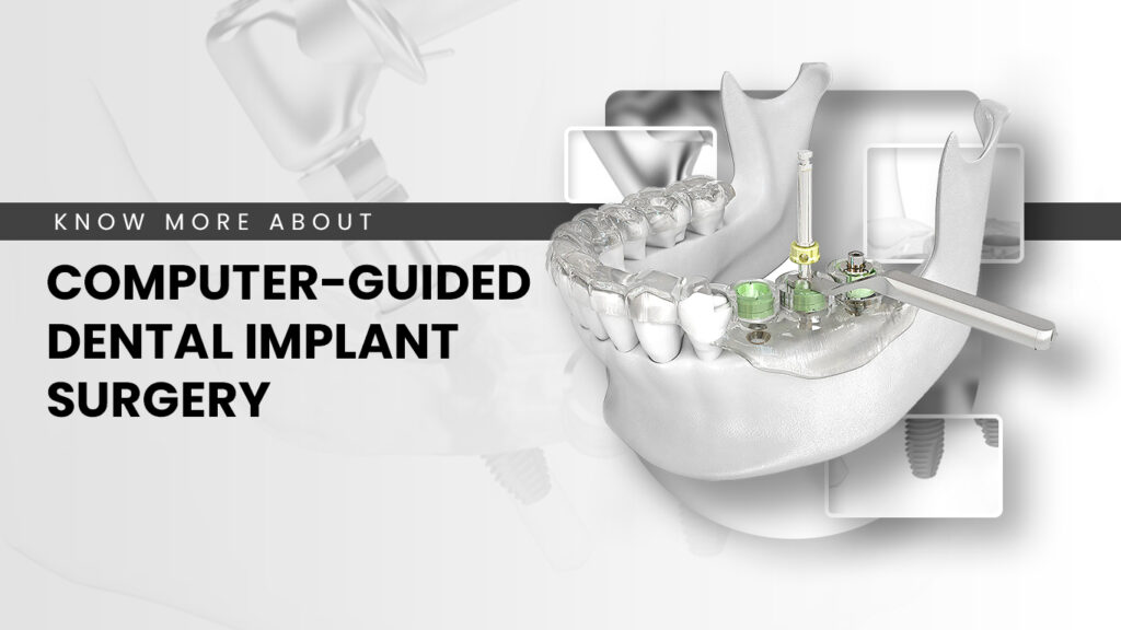 Guided dental Implant