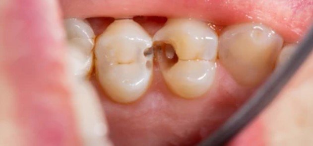 dental cavity
