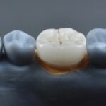 dental crown - a future trouble
