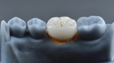 dental crown - a future trouble