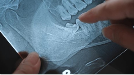 wisdom tooth extraction