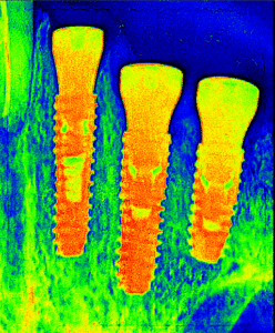 Best Dental Implant clinic In Dhaka