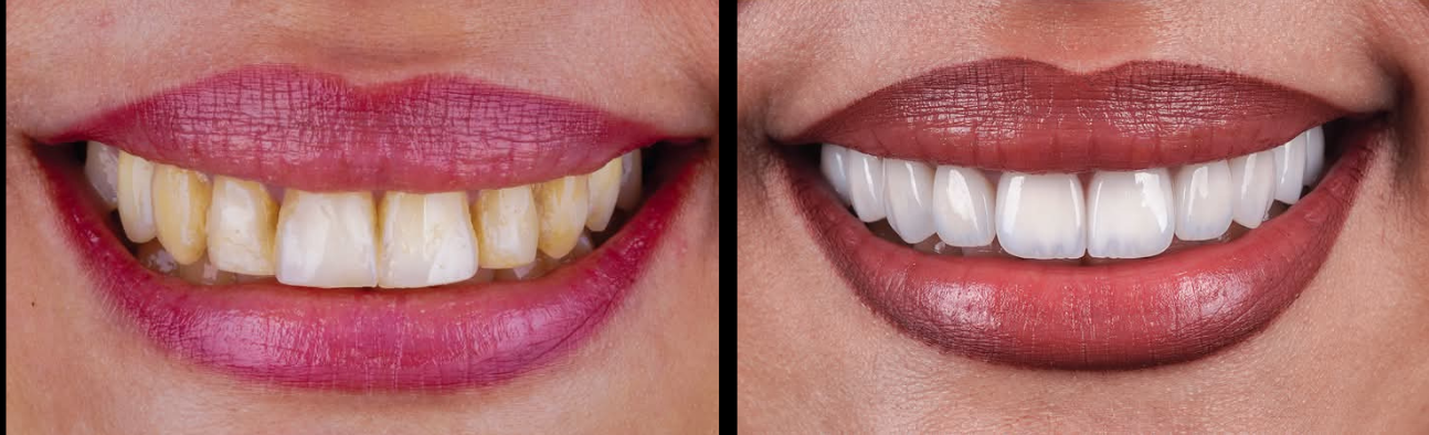 E MAx Dental Veneer in Dhaka