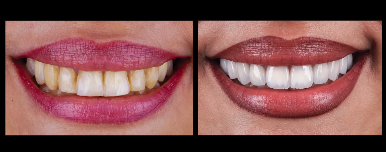 E MAx Dental Veneer