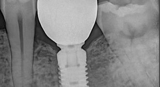 Best dental implant clinic in Dhaka at Banani for missing teeth replacement