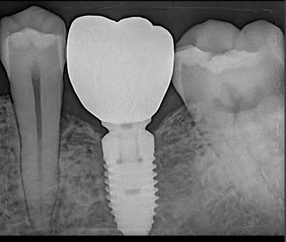 Best dental implant clinic in Dhaka at Banani for missing teeth replacement