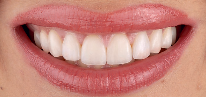 digital smile deign in Dhaka with veneer