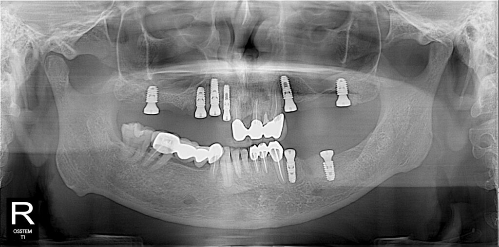 Multiple Implant : top dental Implant in Dhaka