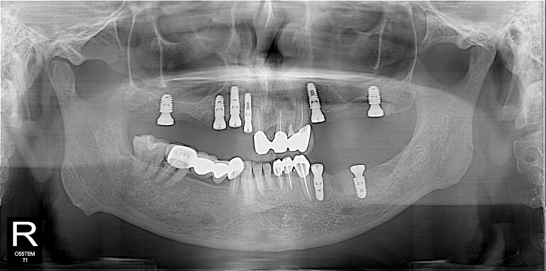 Multiple Implant : top dental Implant center in Dhaka