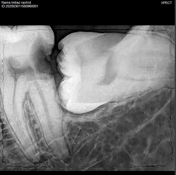 wisdom tooth surgery : best dental clinic in Dhaka