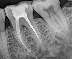 Root Canal treatment in Banani Dhaka
