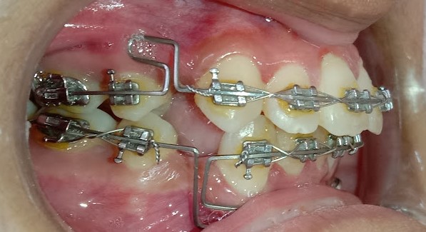 dental Brace