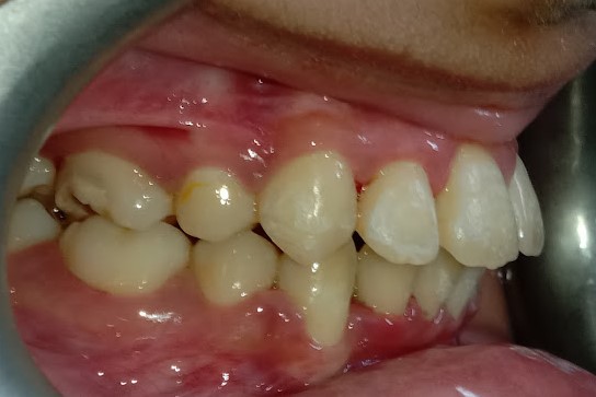 dental brace