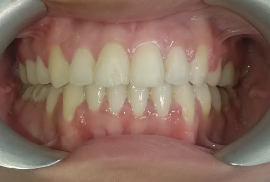 dental Brace