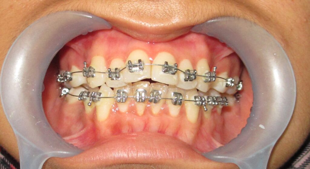 Dental Brace