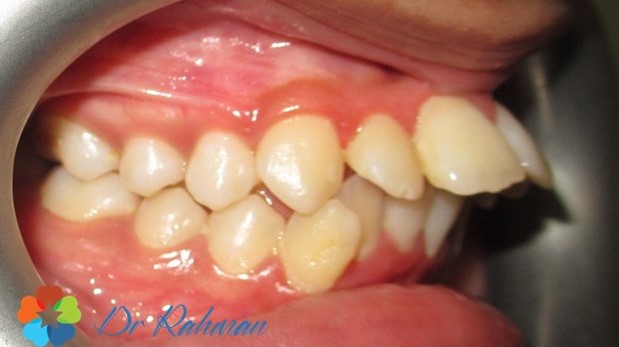 dental Brace