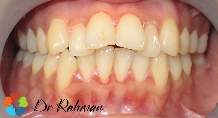 dental Brace