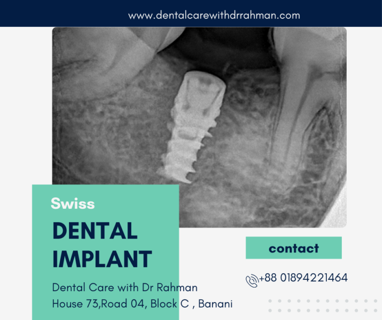 Dental Implants in Dhaka