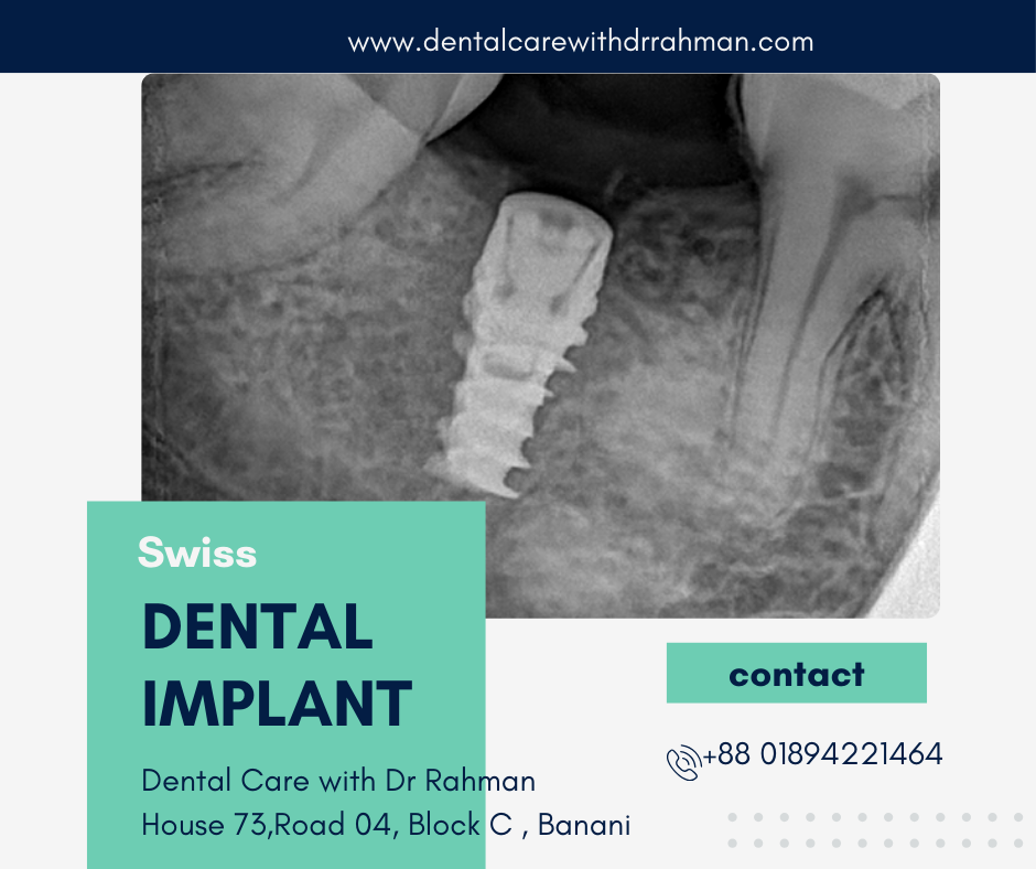 Dental Implants in Dhaka