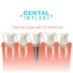 Cost of Dental Implant in Bangladesh