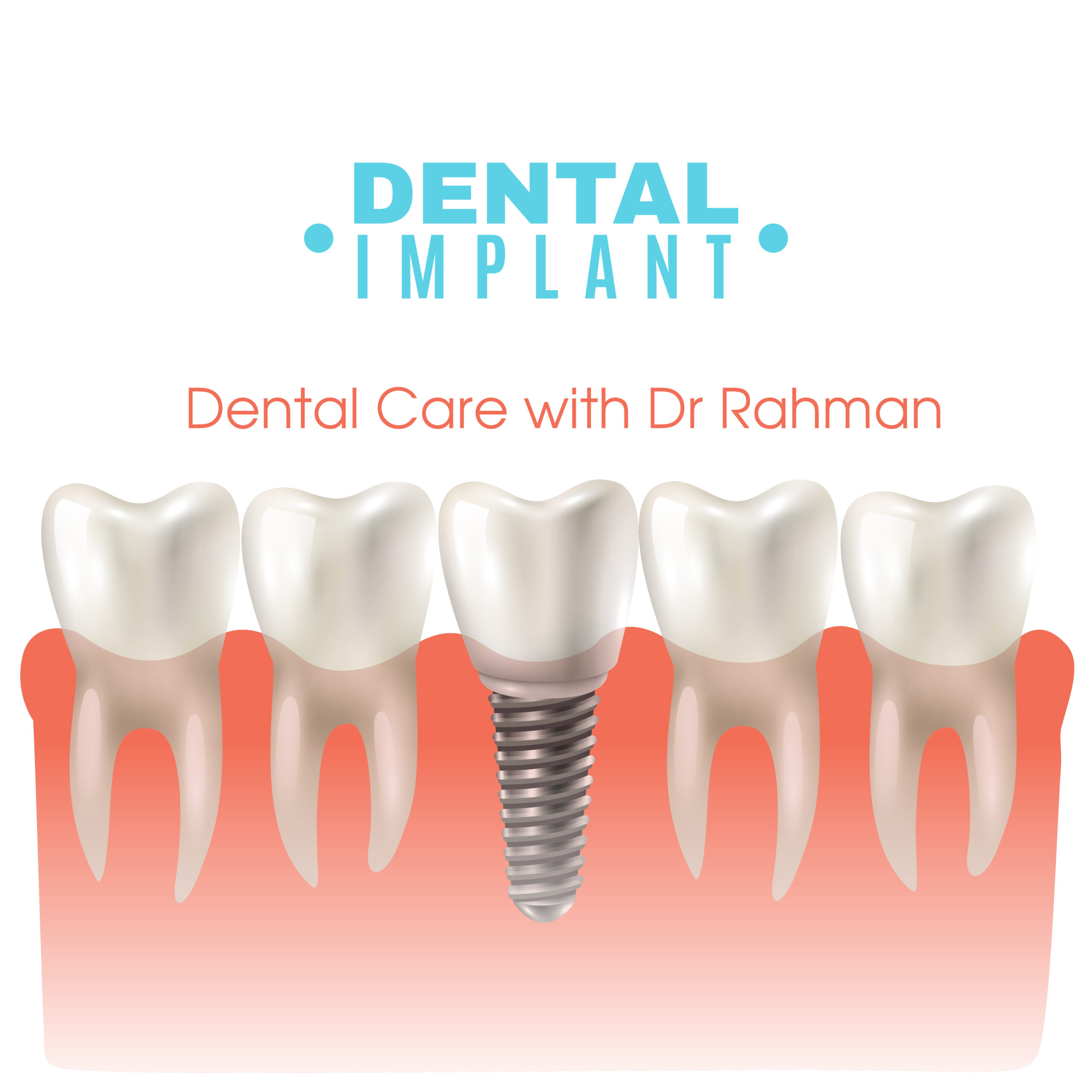 Cost of Dental Implant in Bangladesh