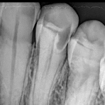 Dental Cavity and prevention