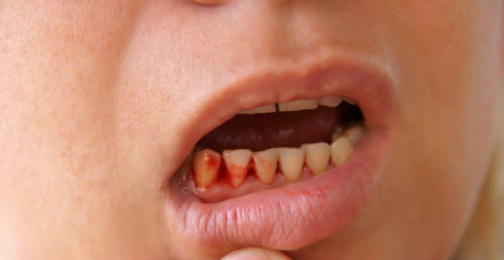 gum bleeding