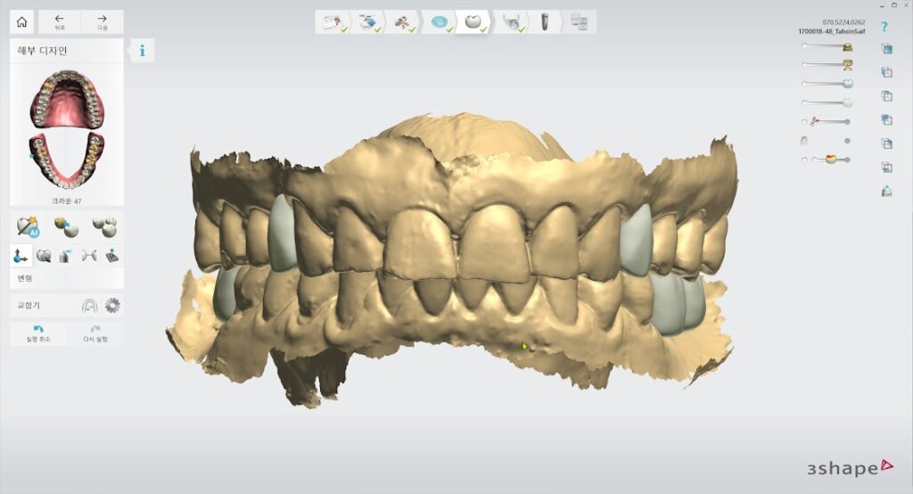 3D guide Scan best dental Implant clinic in Dhaka located at Banani