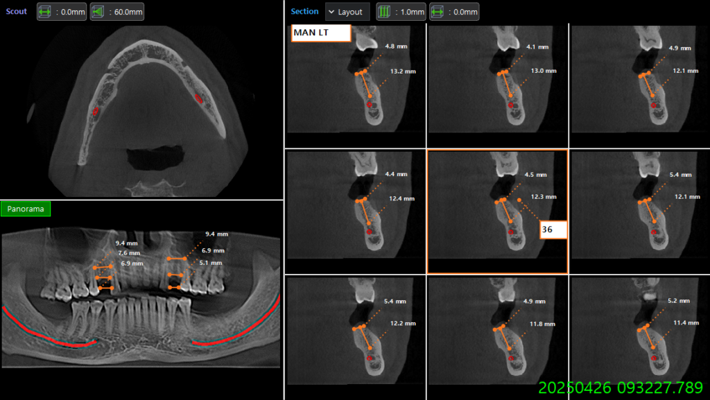 3d guided dental Implant in Dhaka