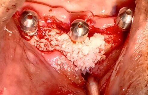 Bone Graft at the site of Implan