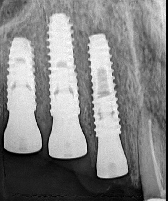 immediate dental implant _ dental implant clinic in Dhaka