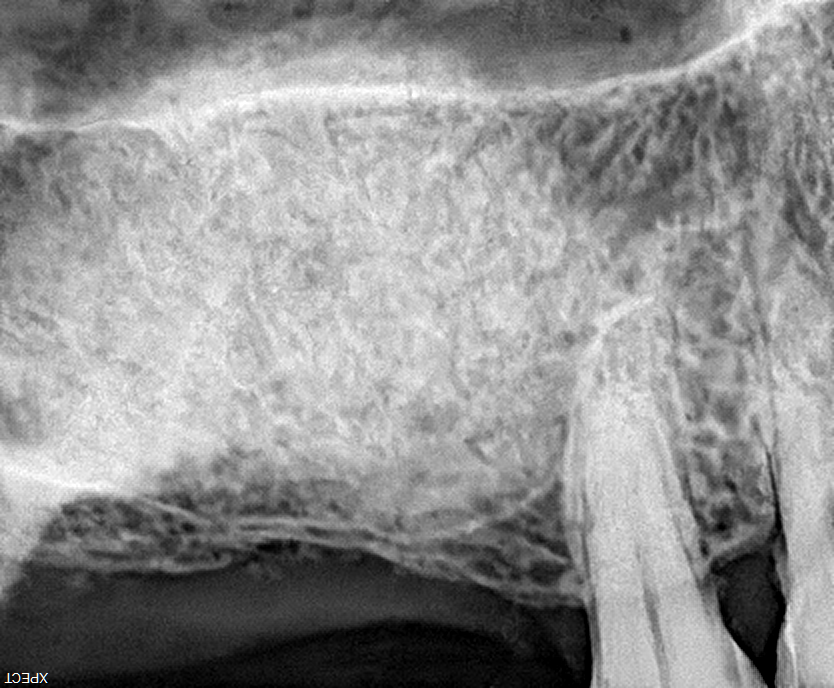 Best dental Implant clinic - bone graft in sinus