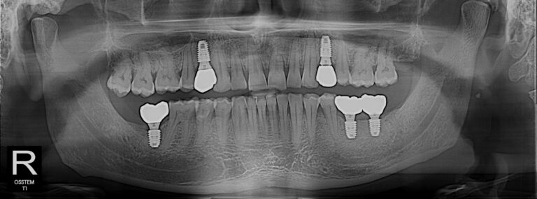 Top dental implant in Dhaka