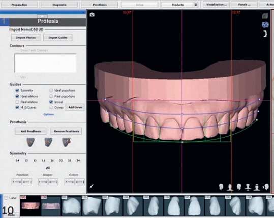 Digital smile design