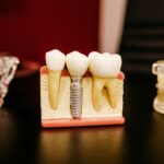 best dental implant in dhaka