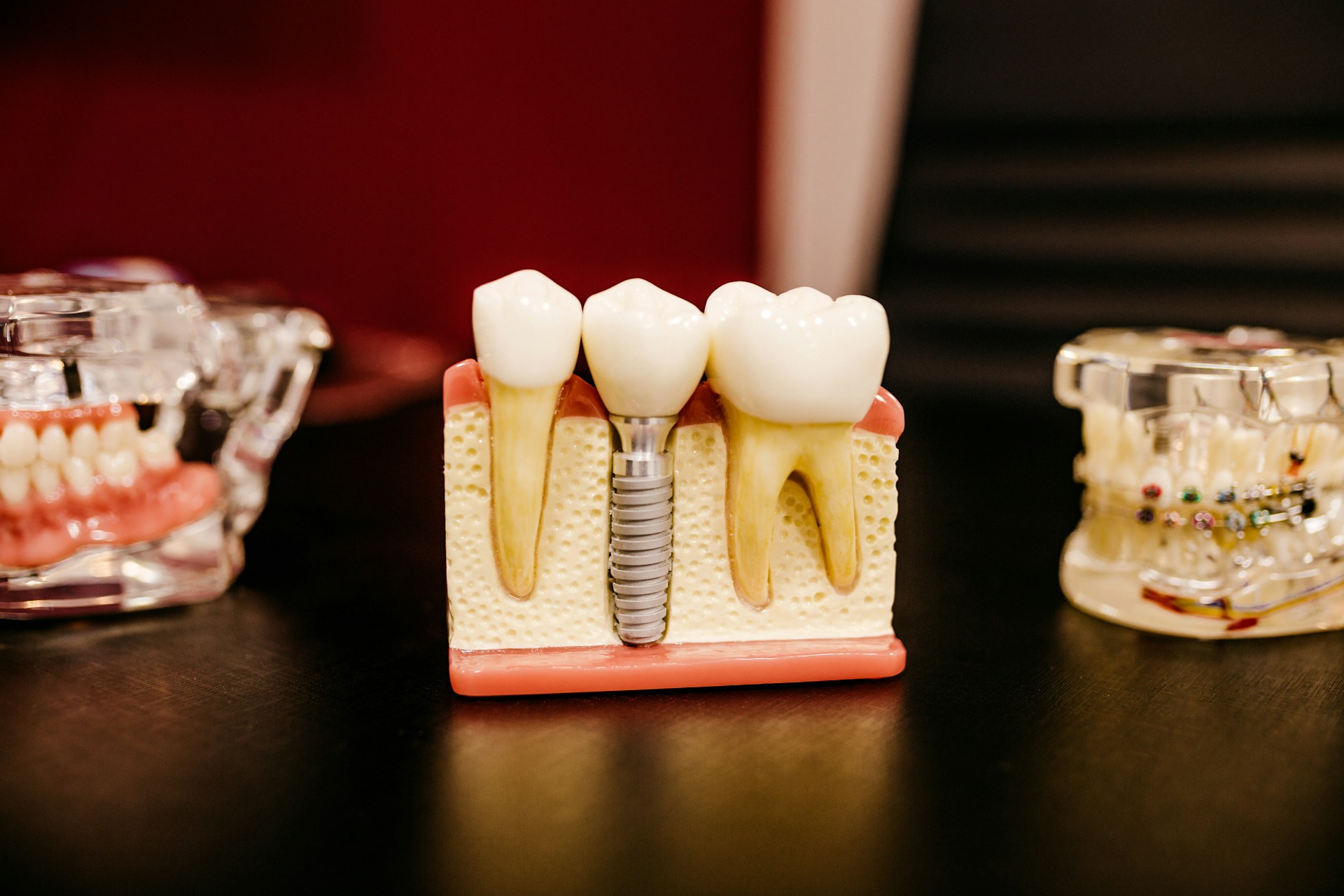 best dental implant in dhaka