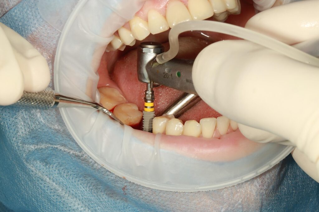 best dental implant in dhaka