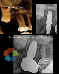 Reetn in a day or denral Implant in a DAy in Dhaka