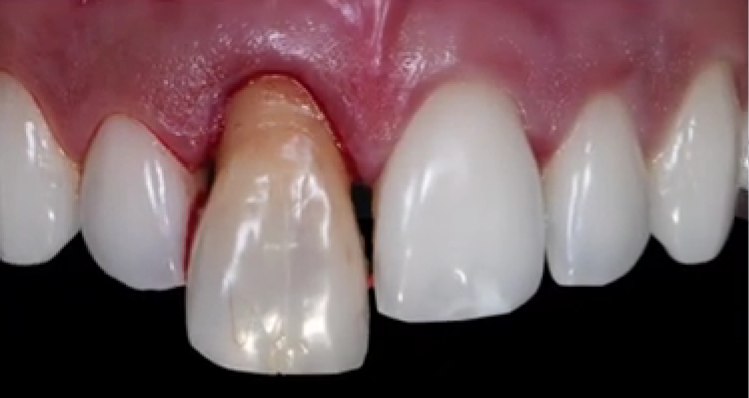 Replace front tooth with implant