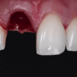Front Teeth Implant