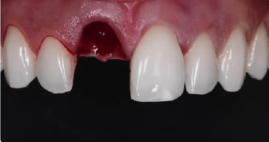 Front Teeth Implant