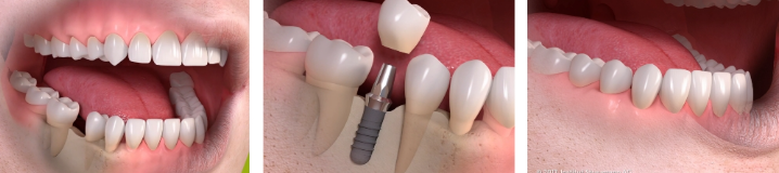 teeth in a day