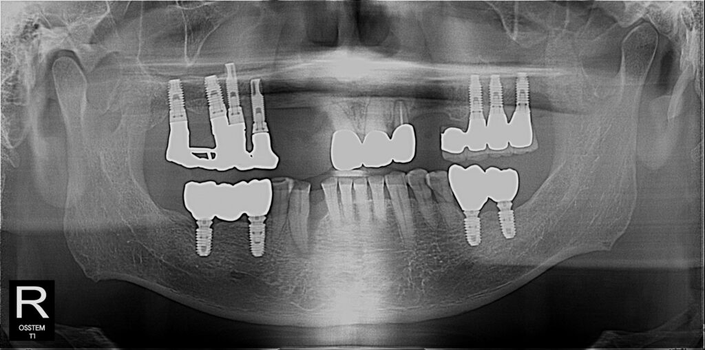 Multiple Dental Implant and Bridge