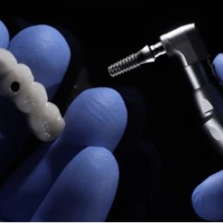 Dental Implant