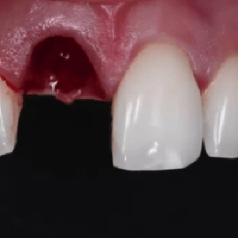 Front Teeth Implant