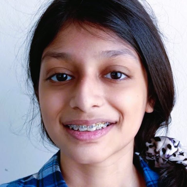 Dental Brace in Dhaka
