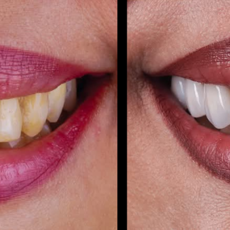 E MAx Dental Veneer in Dhaka