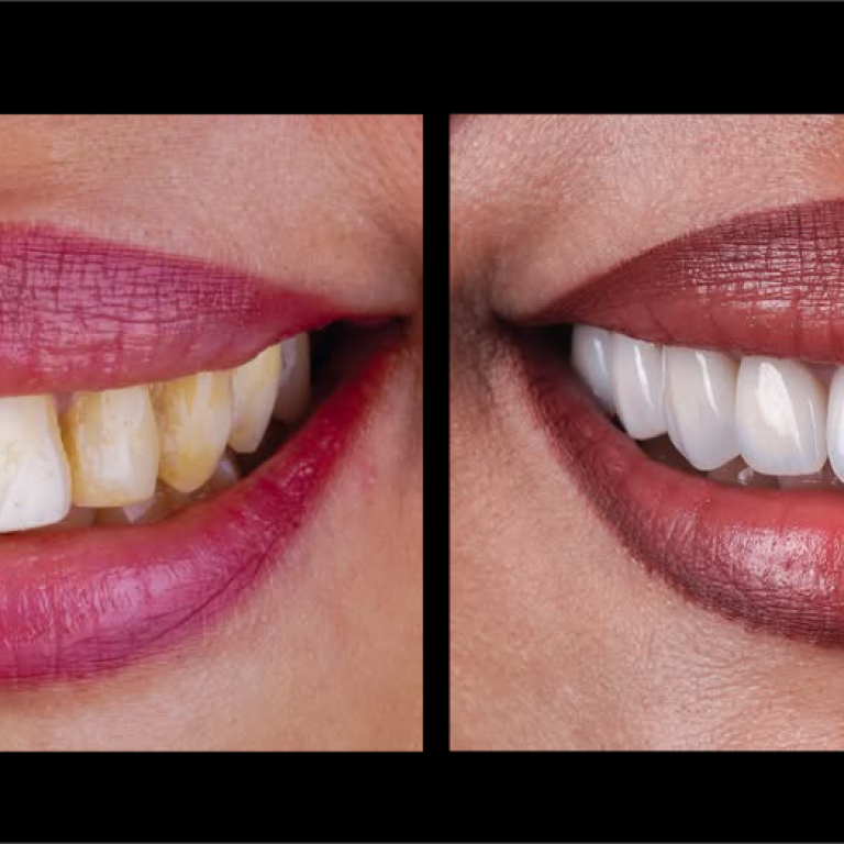 E MAx Dental Veneer in Dhaka